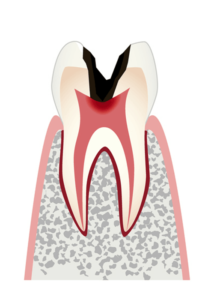 神経まで進⾏した虫歯