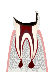 歯冠が⼤きく失われた歯